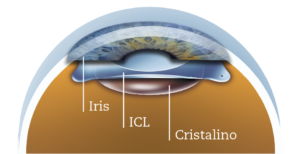 icl lenses3